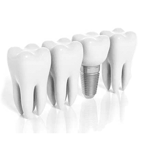 Имплантация зубов уход за установленной конструкцией.png
