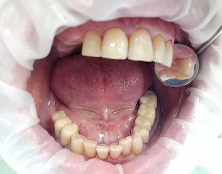 Лечение 23 зуба + полировка передних зубов 