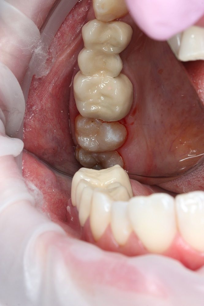 Лечение кариеса 27 зуба