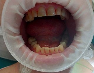 Полировка передних зубов