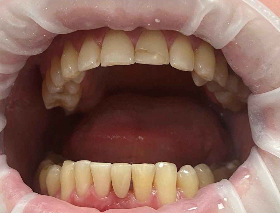 Временная реставрация зуба