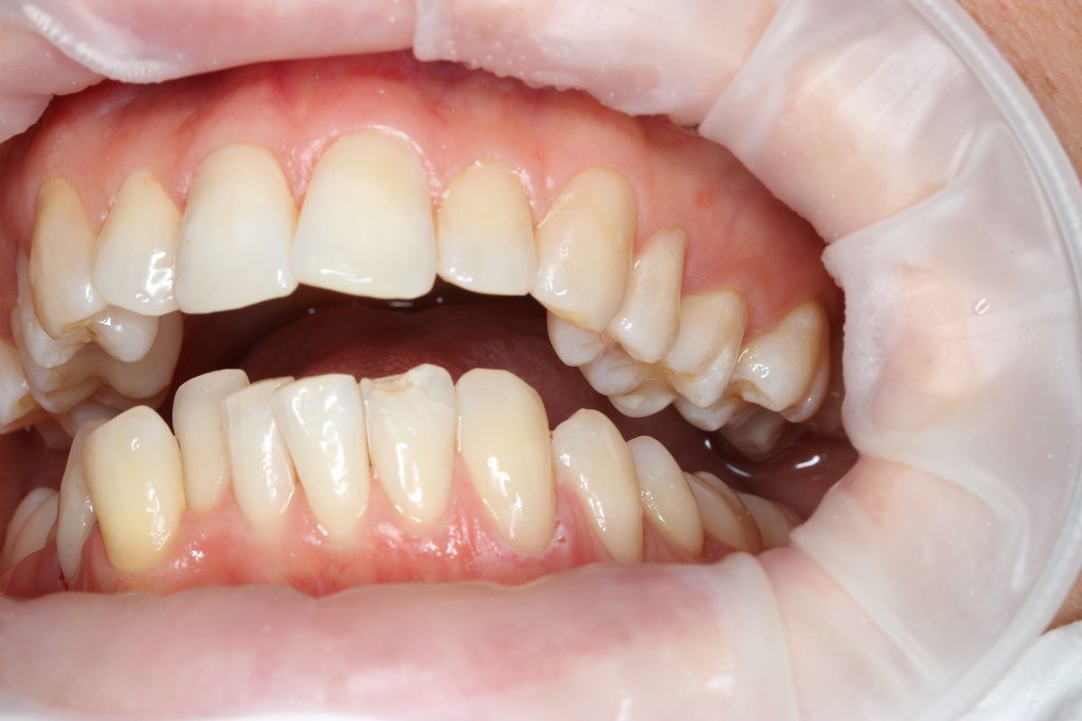 Лечение некариозного поражения 43 зуба