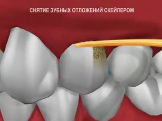 Особенности профессиональной чистки зубного камня