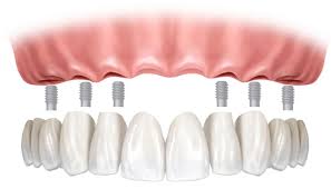 Особенности протезирование верхней челюсти при отсутствии зубов