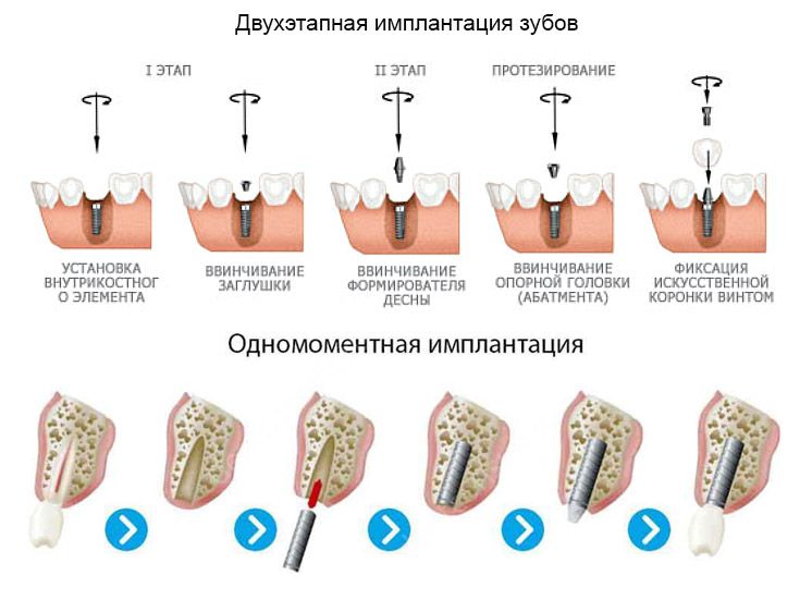 Установка современных зубных имплантатов в Санкт-Петербурге.jpg