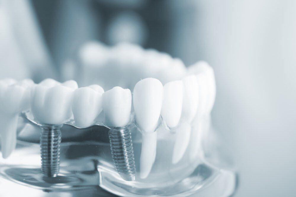Имплантация зубов преимущества и особенности ее проведения