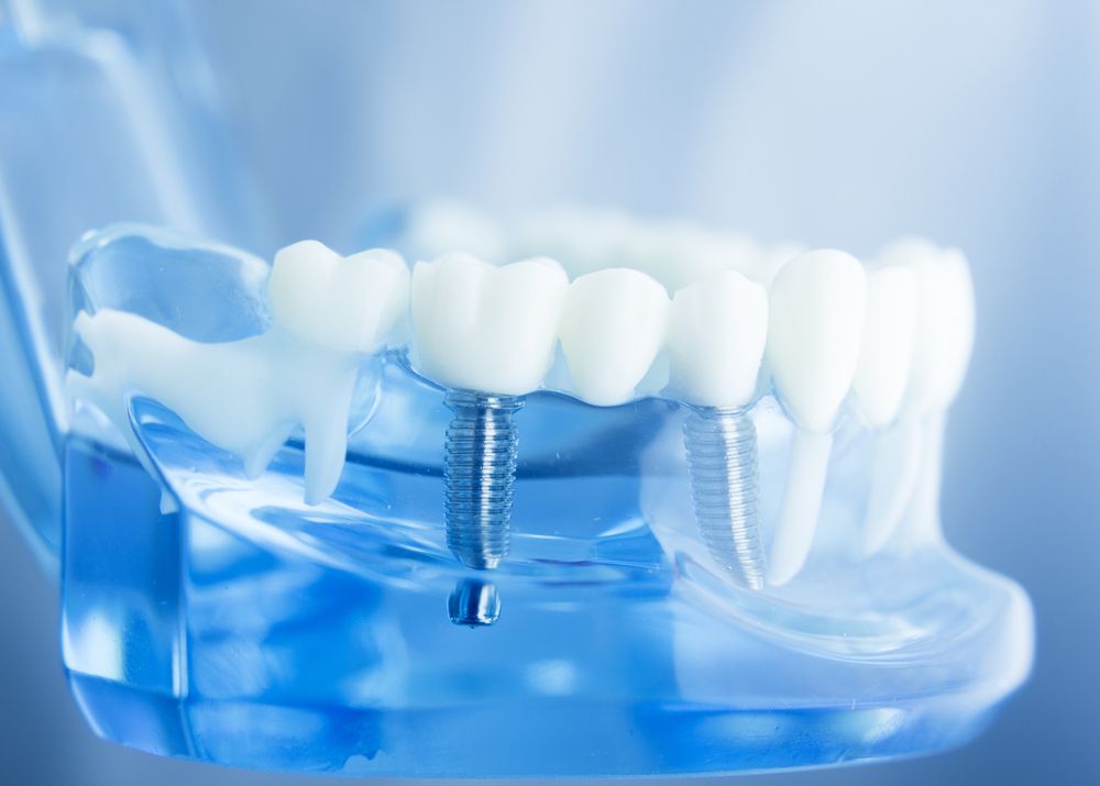 Имплантация зубов в «Клинике ЕС» – выбор №1!.jpg