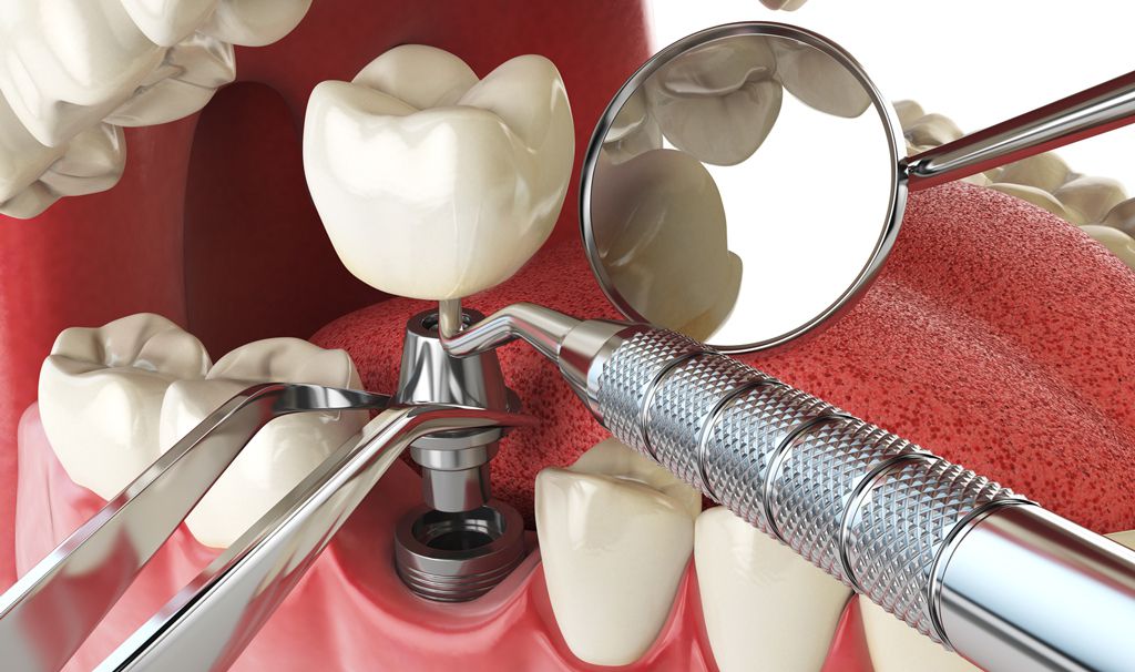 Быстрая имплантация зубов – кратчайший путь к красивой и здоровой улыбке.jpg