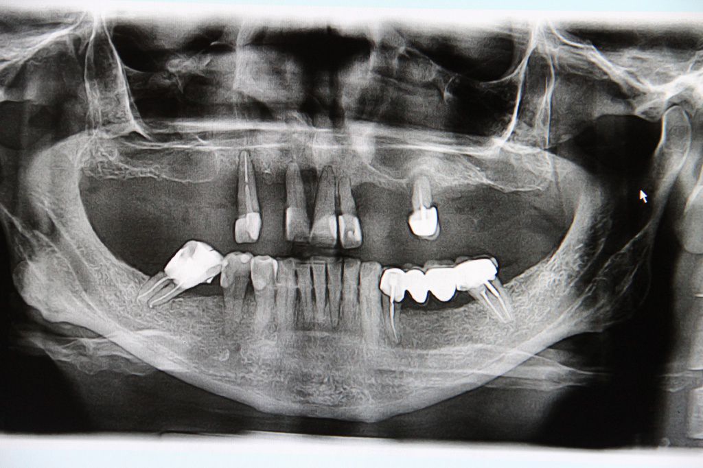 Снимок зубов