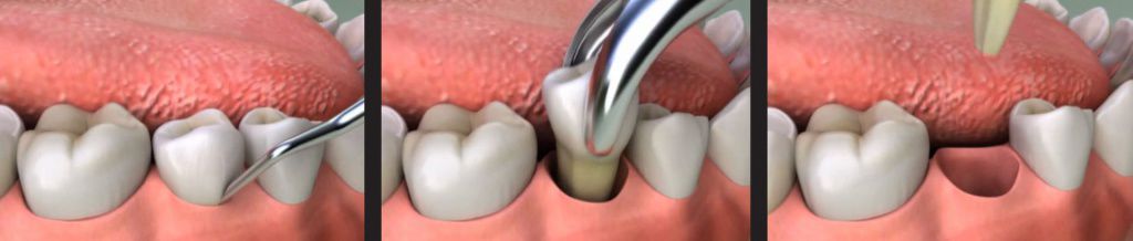 Удаление зуба в хирургическом отделении клиники ЕС