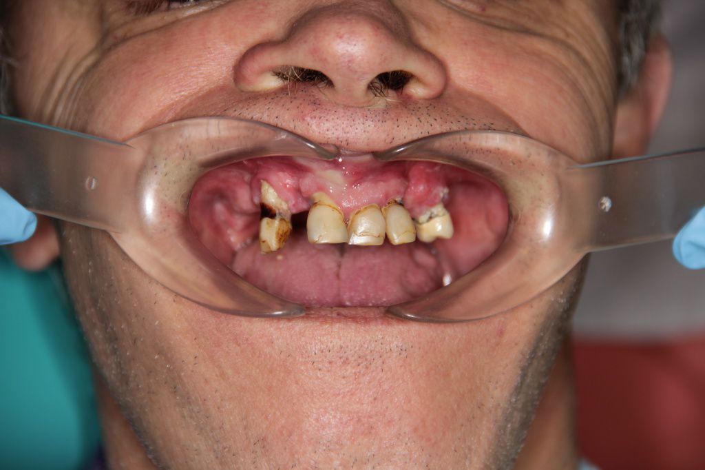 челюсть с отсутствующими зубами