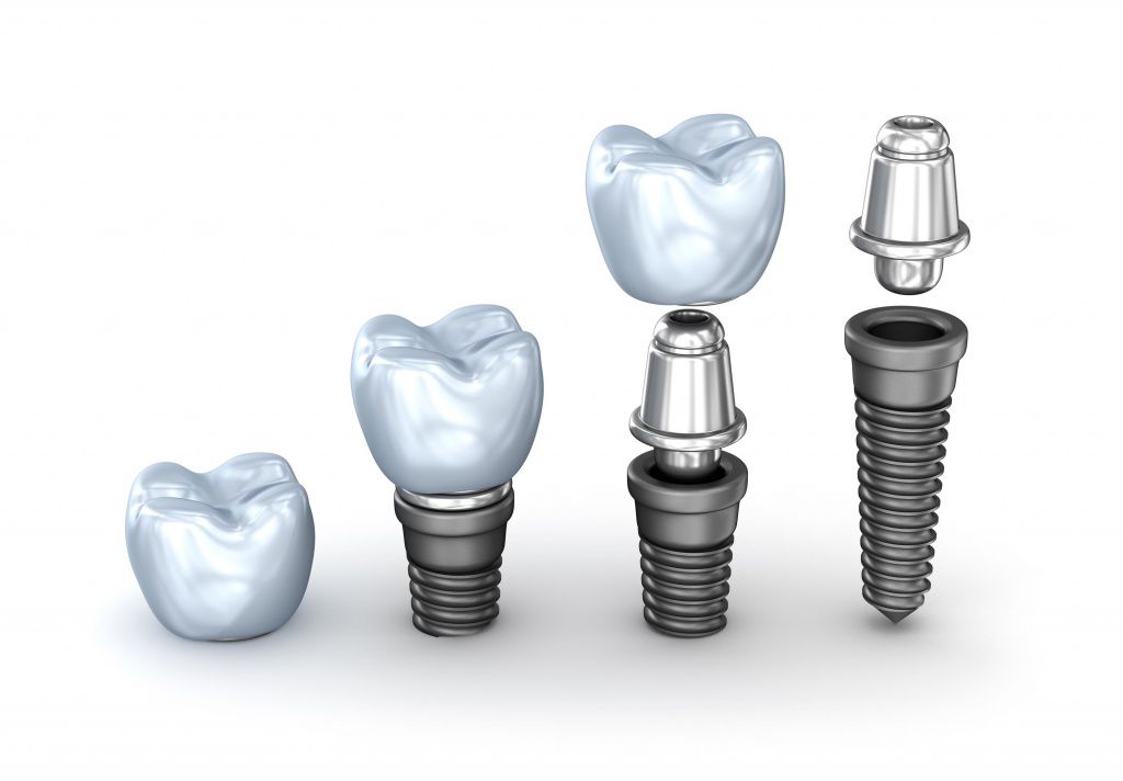 Качественная и недорогая имплантация зубов – в «Клинике ЕС»!