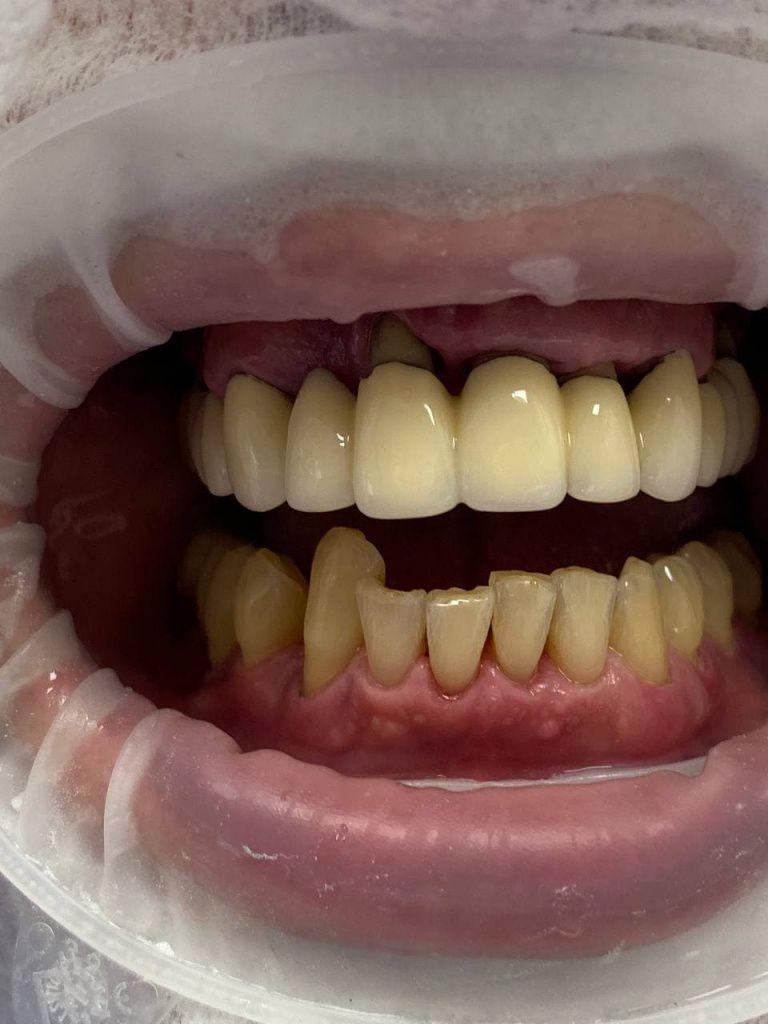 зубы после чистки