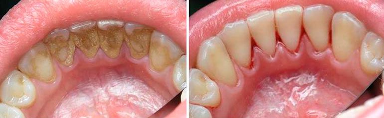 Как появляется зубной камень и чем он опасен?