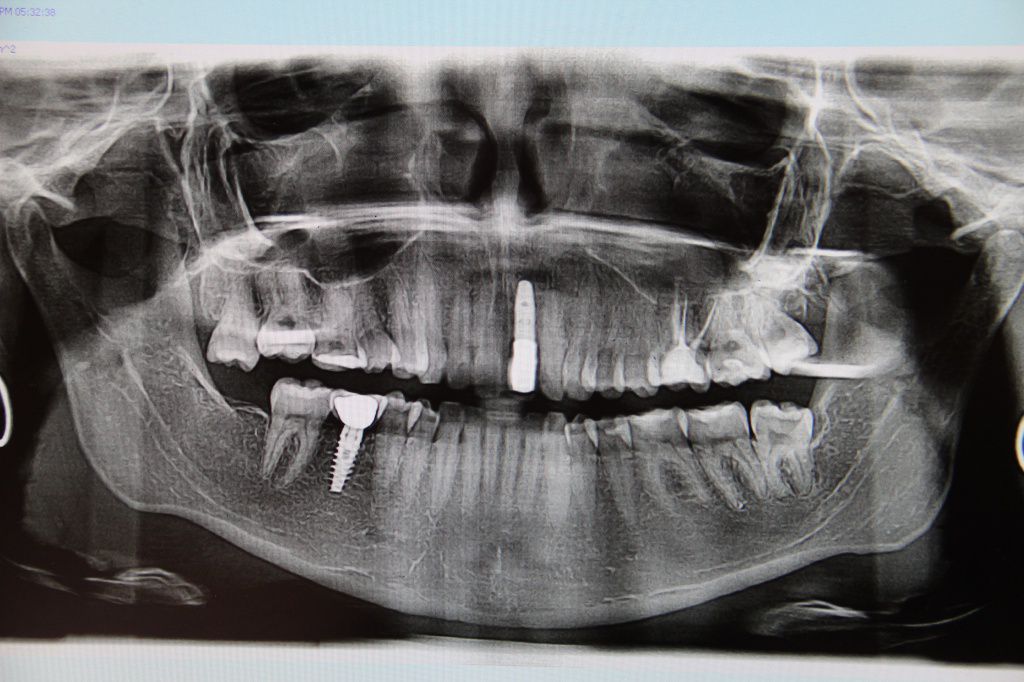 снимок зубов